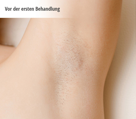 vorher - Haarentfernung mit ILP